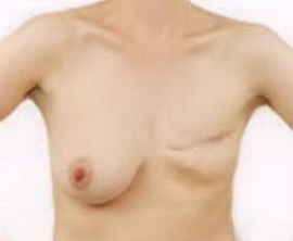 乳腺癌根治术