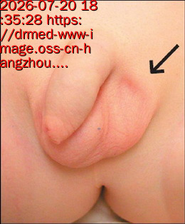 隐睾症